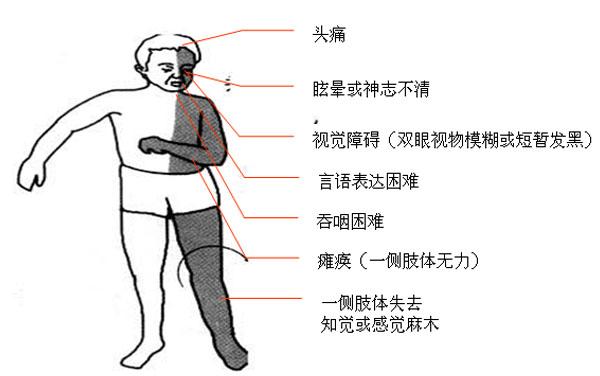 患者通常表现为:①一侧嘴角流口水,不能说话或说话含糊不清;②一边