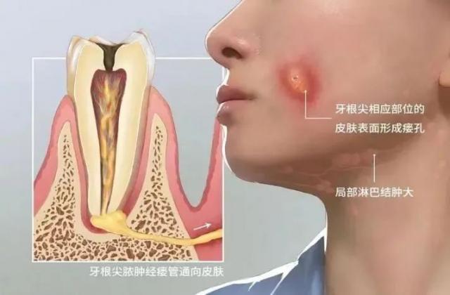 “痘痘”“皮肤感染”总不好？根源竟是牙齿问题！快自查→