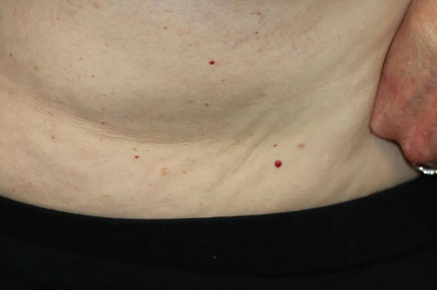 身上长的“小红点”会癌变吗？红痣大多无害，但这3种情况建议就医！