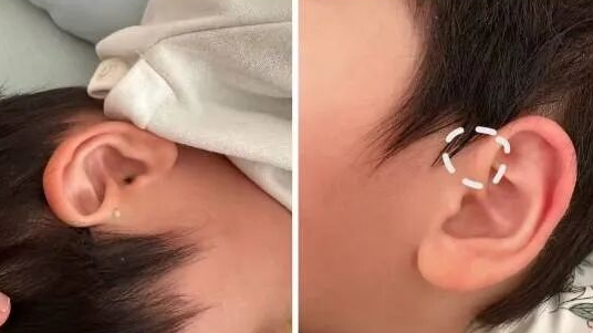 耳朵上的这个小洞，千万别挤
